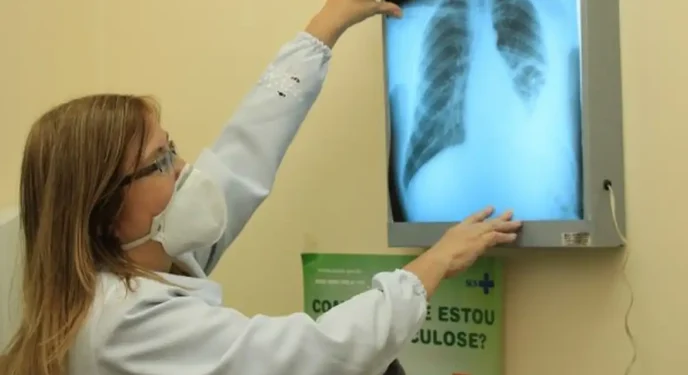 Brasil está na contramão da meta para erradicação da tuberculose