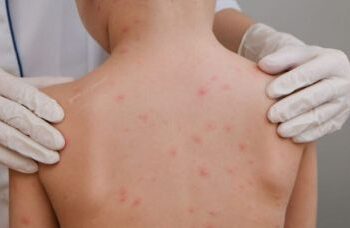 Bahia registra 26 mortes e 572 casos por meningite em 2025